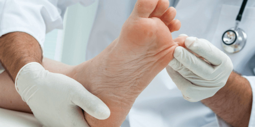 Athlete’s Foot Remedy in Home